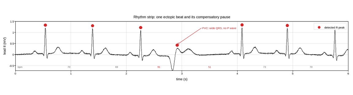 plot 06 ecg rhythm strip